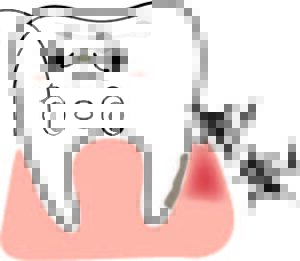 歯周病菌